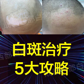 成都西部白癜风医院