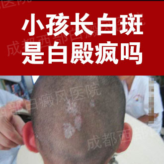 成都西部白癜风医院