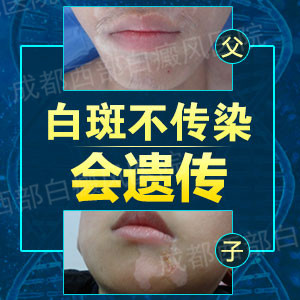 成都西部白癜风医院