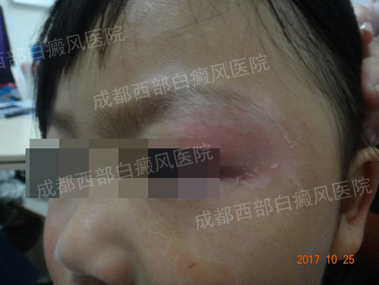 成都西部2018年白癜风康复案例