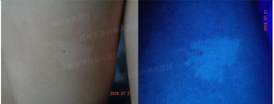 2018白癜风康复案例