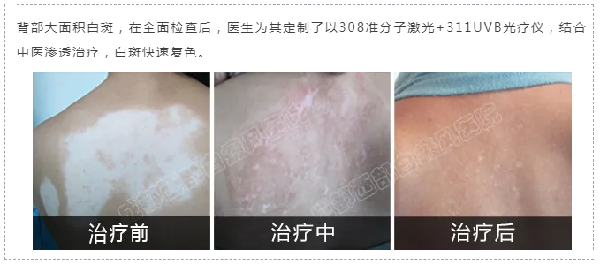 成都西部白癜风医院